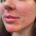 Filler Before & After Patient #742