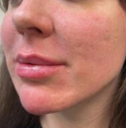 Filler Before & After Patient #742
