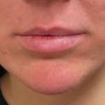 Filler Before & After Patient #742