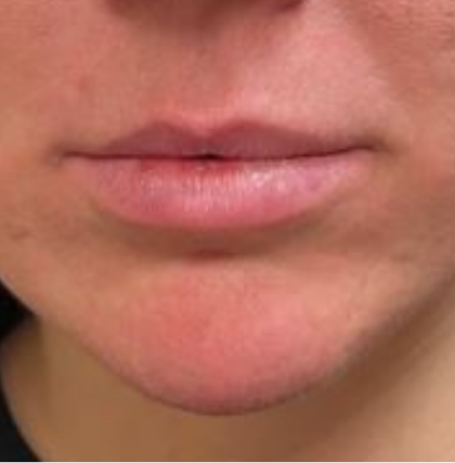 Filler Before & After Patient #742