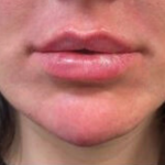 Filler Before & After Patient #742