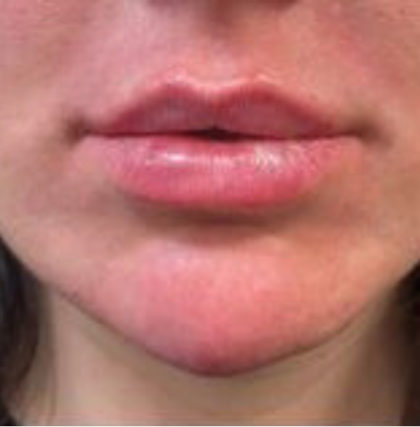 Filler Before & After Patient #742