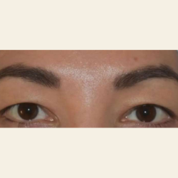 Blepharoplasty Before & After Patient #110