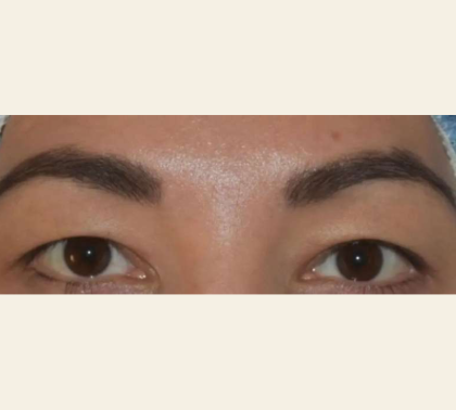 Blepharoplasty Before & After Patient #110