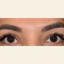 Blepharoplasty Before & After Patient #110