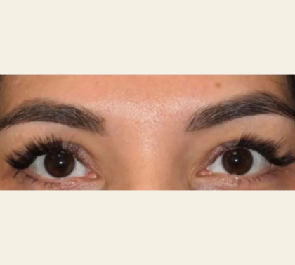 Blepharoplasty Before & After Patient #110