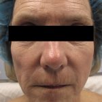 Fractional CO2 Laser Before & After Patient #134
