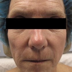 Fractional CO2 Laser Before & After Patient #134