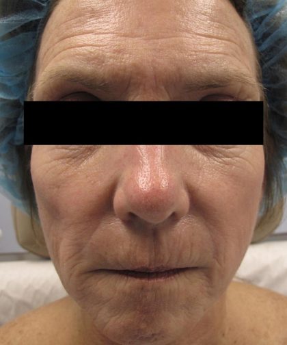 Fractional CO2 Laser Before & After Patient #134