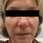 Fractional CO2 Laser Before & After Patient #134
