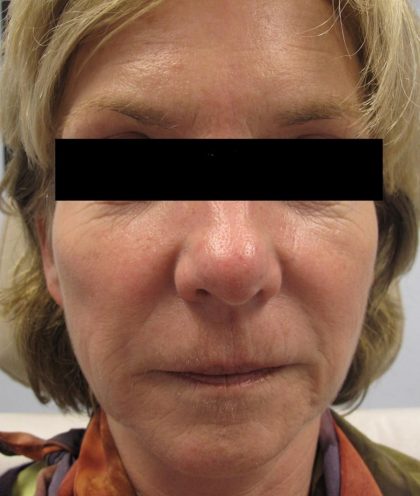 Fractional CO2 Laser Before & After Patient #134
