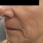 Fractional CO2 Laser Before & After Patient #134