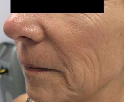 Fractional CO2 Laser Before & After Patient #134