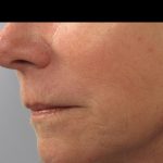 Fractional CO2 Laser Before & After Patient #134