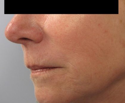 Fractional CO2 Laser Before & After Patient #134