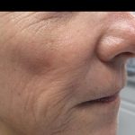 Fractional CO2 Laser Before & After Patient #134