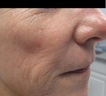 Fractional CO2 Laser Before & After Patient #134