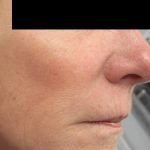 Fractional CO2 Laser Before & After Patient #134