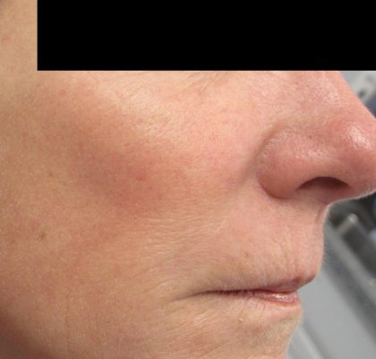 Fractional CO2 Laser Before & After Patient #134