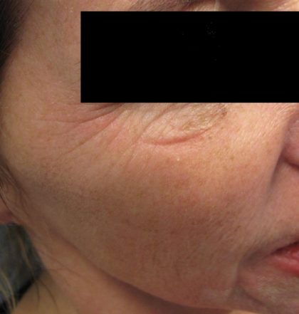 Fractional CO2 Laser Before & After Patient #134