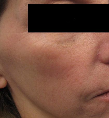 Fractional CO2 Laser Before & After Patient #134