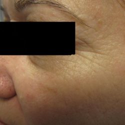 Fractional CO2 Laser Before & After Patient #125