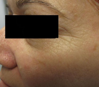 Fractional CO2 Laser Before & After Patient #125