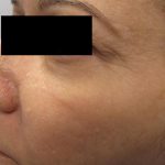 Fractional CO2 Laser Before & After Patient #125