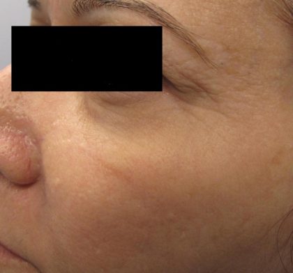 Fractional CO2 Laser Before & After Patient #125