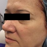 Fractional CO2 Laser Before & After Patient #125
