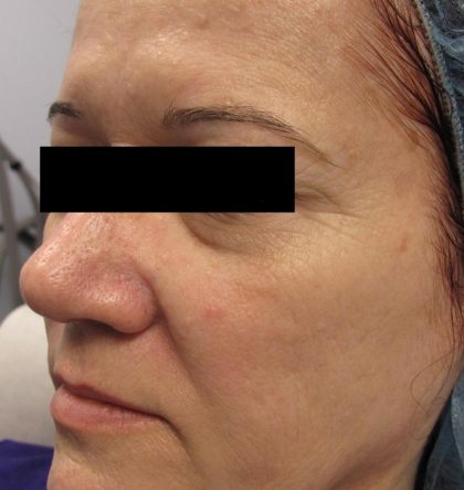 Fractional CO2 Laser Before & After Patient #125