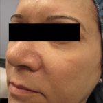 Fractional CO2 Laser Before & After Patient #125