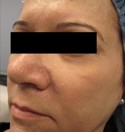 Fractional CO2 Laser Before & After Patient #125