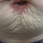 Fractional CO2 Laser Before & After Patient #113