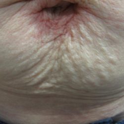 Fractional CO2 Laser Before & After Patient #113