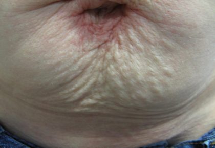 Fractional CO2 Laser Before & After Patient #113