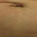 Fractional CO2 Laser Before & After Patient #113