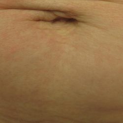 Fractional CO2 Laser Before & After Patient #113