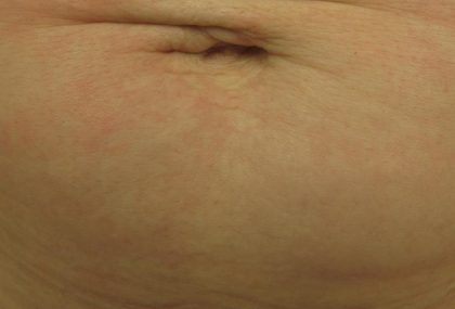 Fractional CO2 Laser Before & After Patient #113