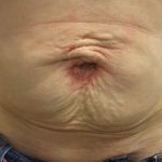 Fractional CO2 Laser Before & After Patient #113
