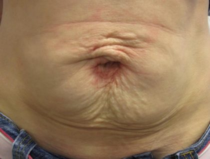 Fractional CO2 Laser Before & After Patient #113