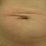 Fractional CO2 Laser Before & After Patient #113