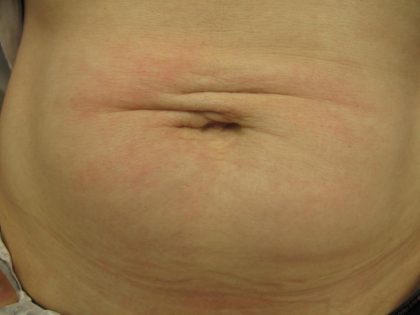 Fractional CO2 Laser Before & After Patient #113
