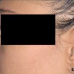 Rhinoplasty Before & After Patient #92