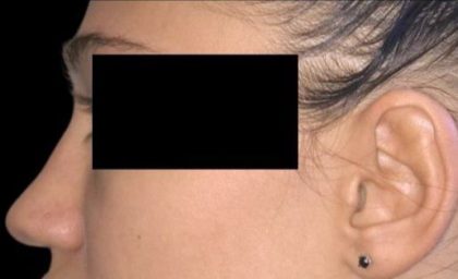 Rhinoplasty Before & After Patient #92