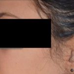 Rhinoplasty Before & After Patient #92