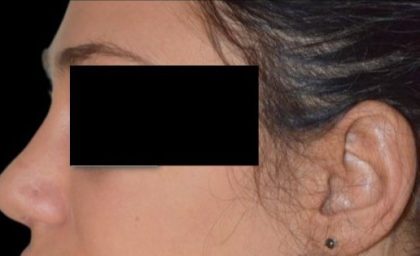 Rhinoplasty Before & After Patient #92