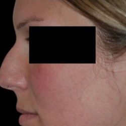 Rhinoplasty Before & After Patient #81