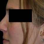 Rhinoplasty Before & After Patient #81