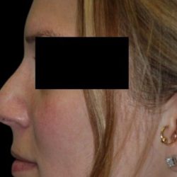 Rhinoplasty Before & After Patient #81